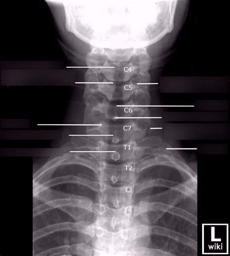 ap soft tissue neck x ray.